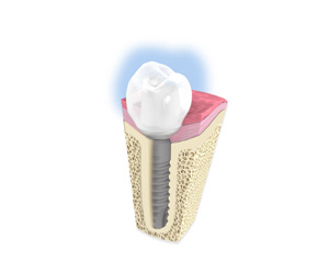 Implant Dentaire Paris 16
