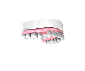 Remplacer-une-dent Implant Dentaire Paris 16